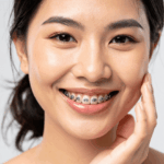 Straightening Your Smile with Braces: What You Need to Know