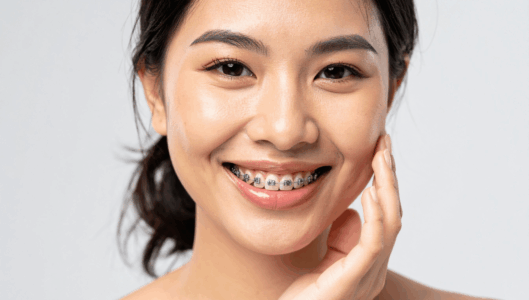 Straightening Your Smile with Braces: What You Need to Know